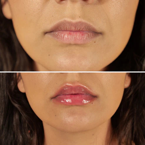 Avant et après repulpeur lèvres effet repulpant naturel bouche fermée