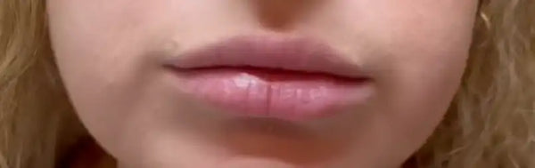 Lèvres de Marylène avant application du Repulpeur Lèvres Extrême - Bymee Cosmetics